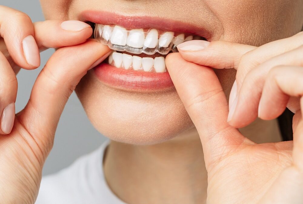 Invisalign; dental makeover