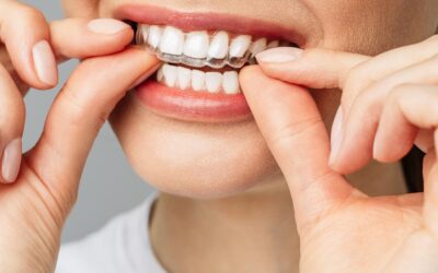 Invisalign Dentist in Marvin NC: Adapting to Aligners