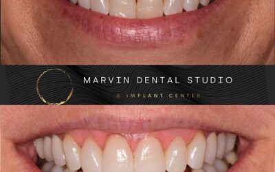 Cosmetic dentist in Marvin & Waxhaw NC for Restorative Dentistry