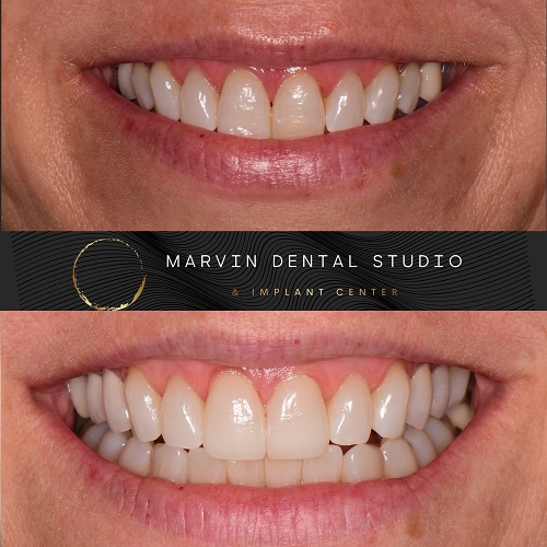 Cosmetic dentist in Marvin & Waxhaw NC for Restorative Dentistry