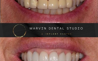 Professional teeth whitening at the dentist at Marvin and Waxhaw NC