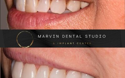 Professional Teeth Whitening with your Marvin and Waxhaw NC dentist