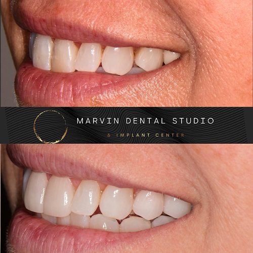 Professional Teeth Whitening with your Marvin and Waxhaw NC dentist